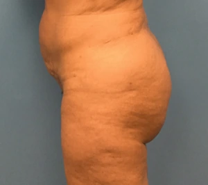 Brazilian-Butt-Lift-Case--74 | After Brazilian Butt Lift 1