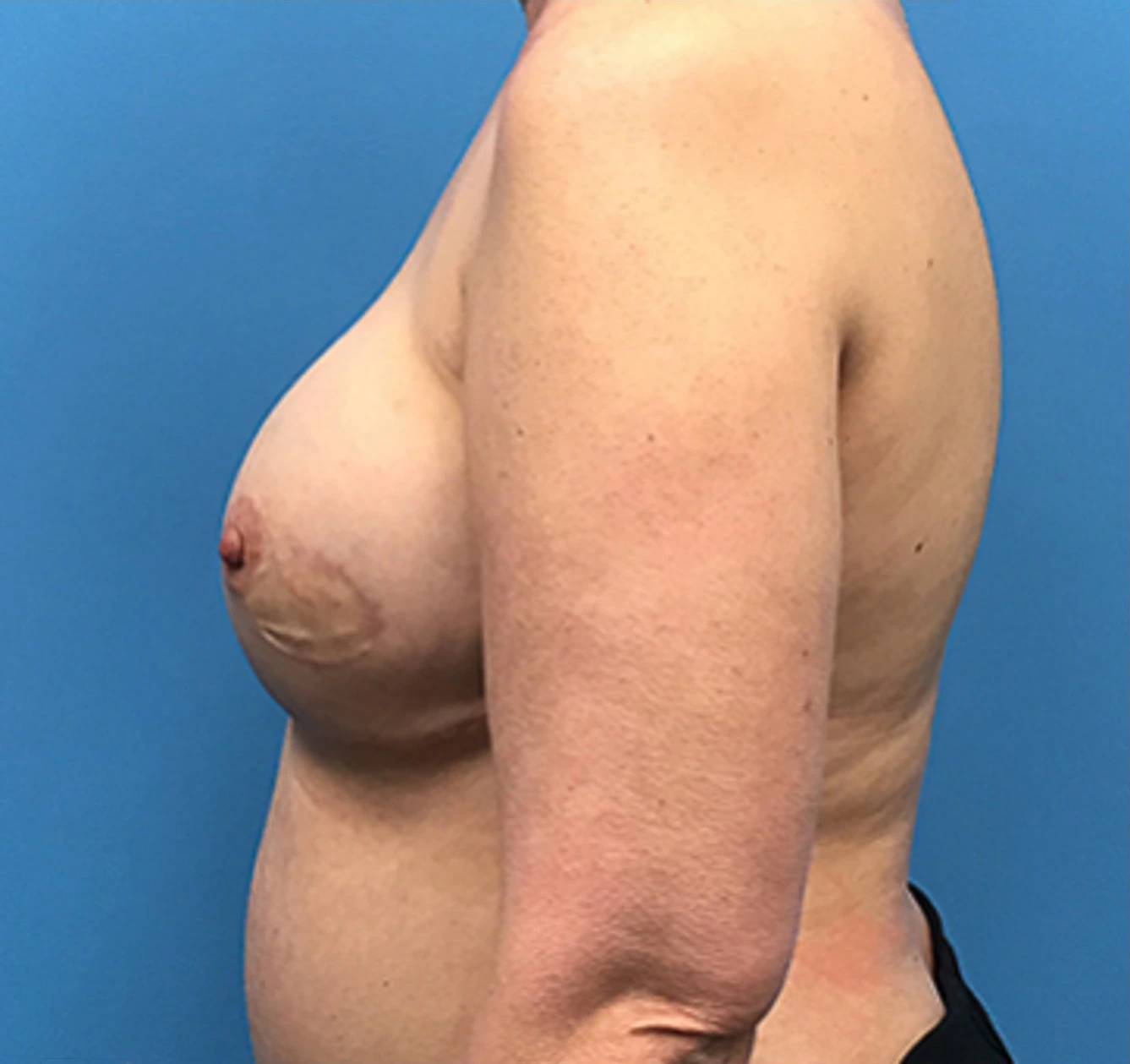 Case--136 | After Breast Reconstruction 2