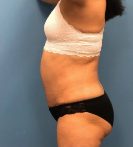 Case--14819 | After Liposuction 2