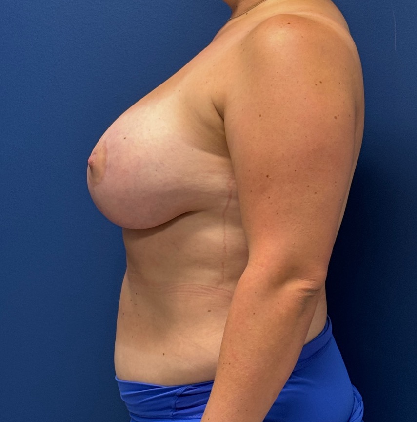 Breast-Augmentation-Mastopexy-Case--29079 | After Breast Augmentation With Lift 4