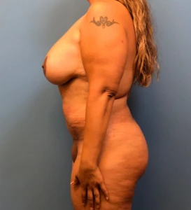 Lipoabdominoplasty-Breast-Augmentation-Case--15133 | After Mommy Makeover 2