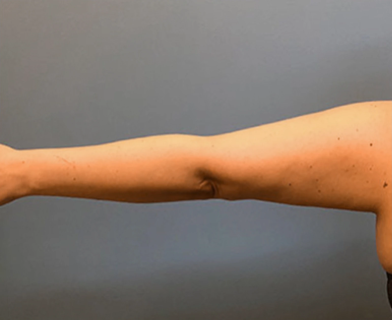 Brachioplasty-Case--78 | After Arm Lift 4