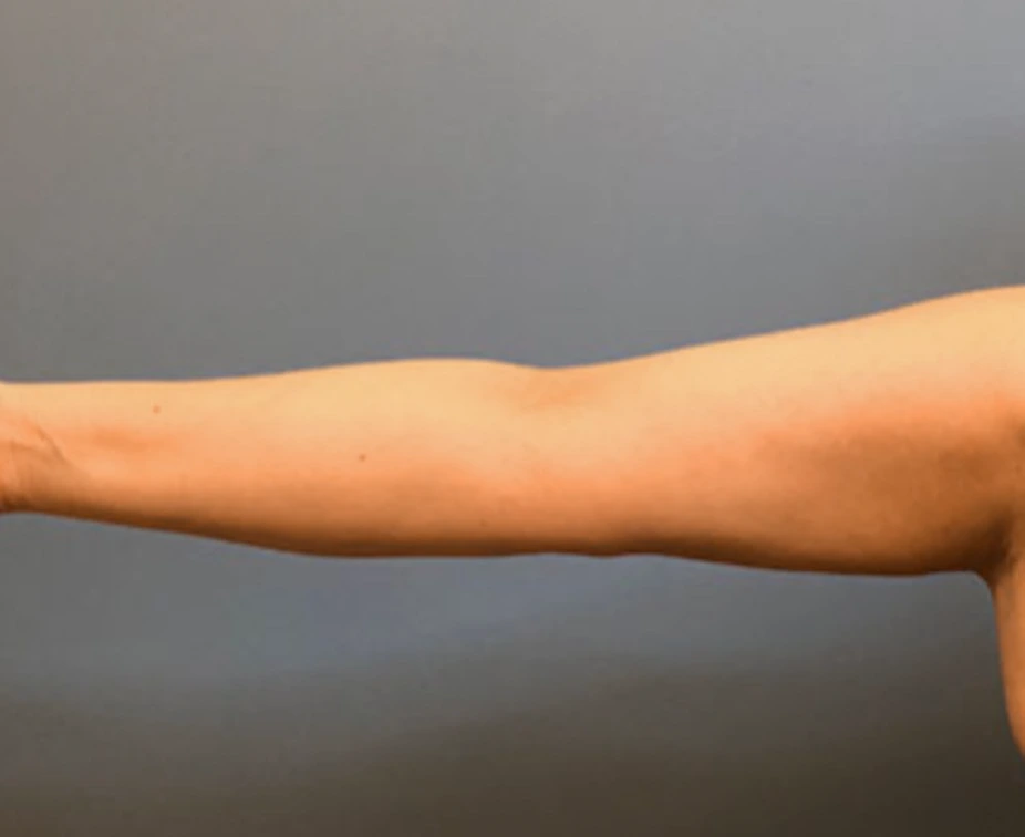 Brachioplasty-Case--78 | After Arm Lift 1