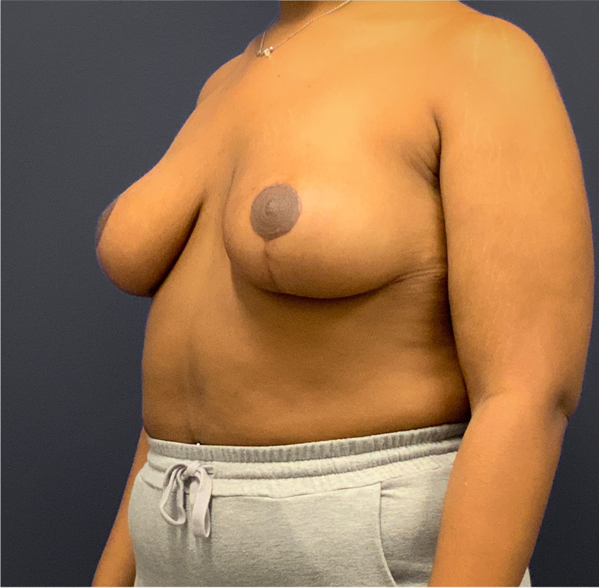 Breast-Reduction-Case--5320 | After Breast Reduction 4