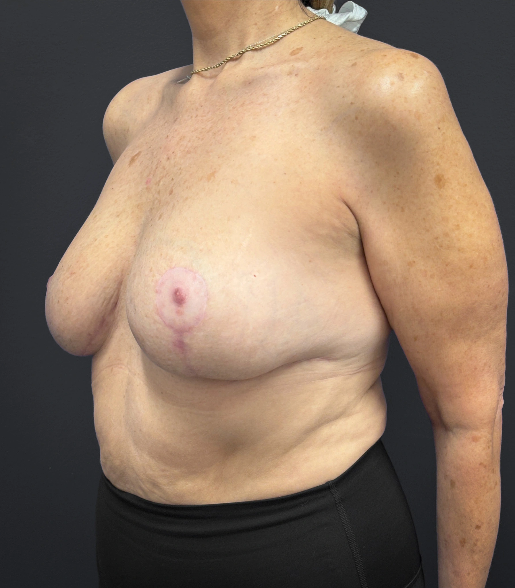 Breast-Reduction-Case--2538 | After Breast Reduction 4