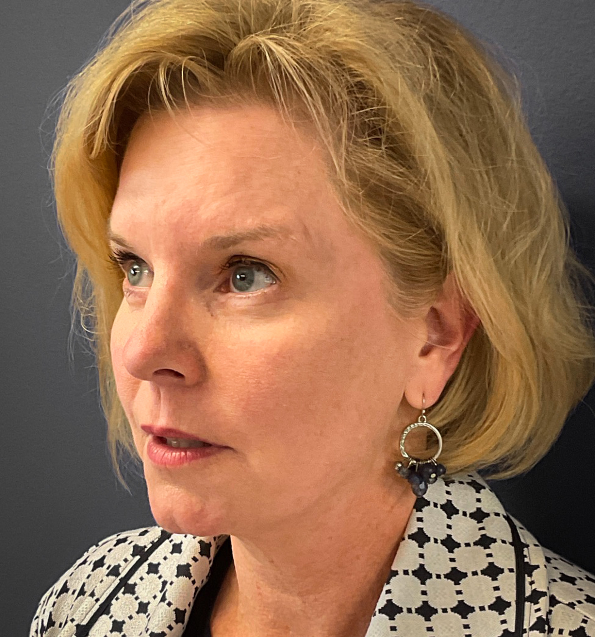 Blepharoplasty-Case--7015 | After Eyelid Surgery 5