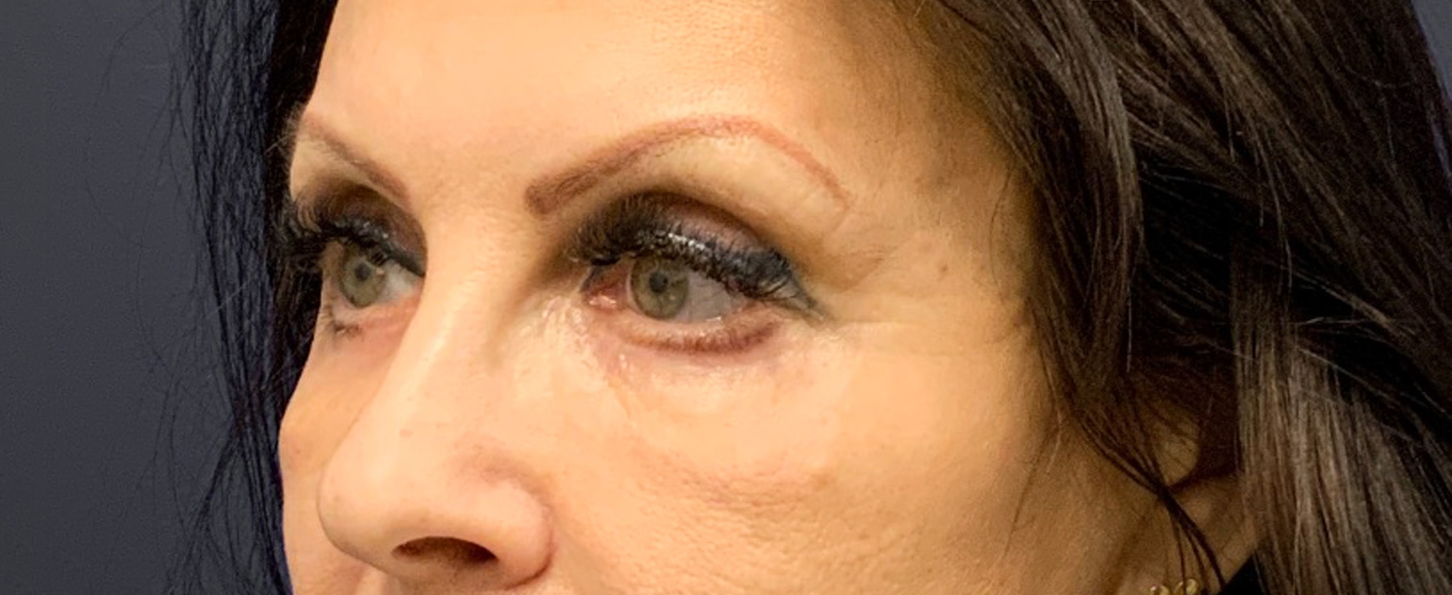 Blepharoplasty-Case--6272 | After Eyelid Surgery 7