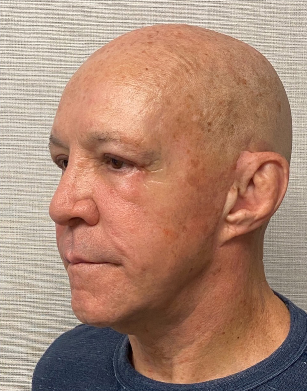 Blepharoplasty-Case--24169 | After Eyelid Surgery 3