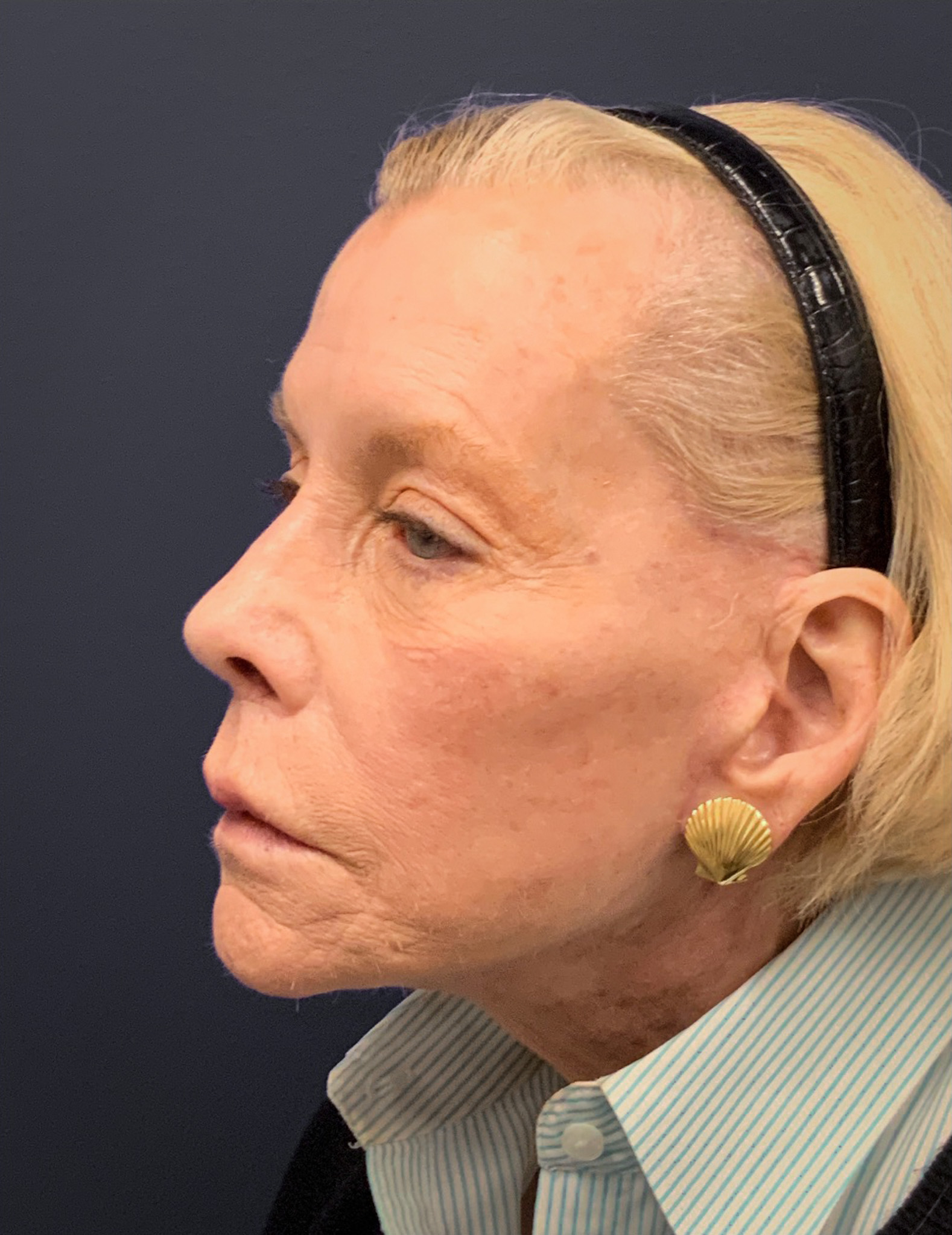 Facelift-Case--7247 | After Facelift 5