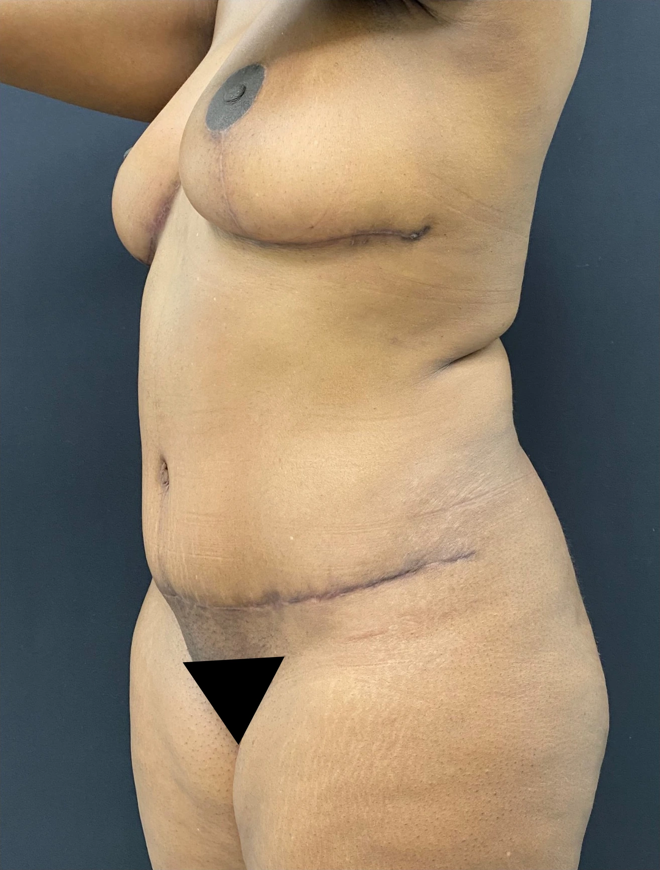 Mommy-makeover-Case--336 | After Mommy Makeover 4