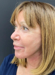 Facelift-Case--365 | After Facelift 2