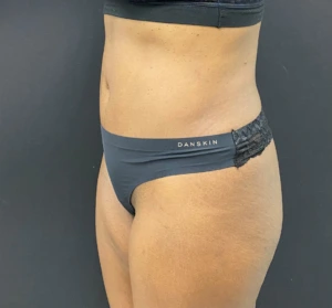 Abdominoplasty-Case--340 | After Tummy Tuck 2
