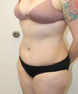 Liposuction-Tummy-Tuck-Case--343 | After Liposuction 2