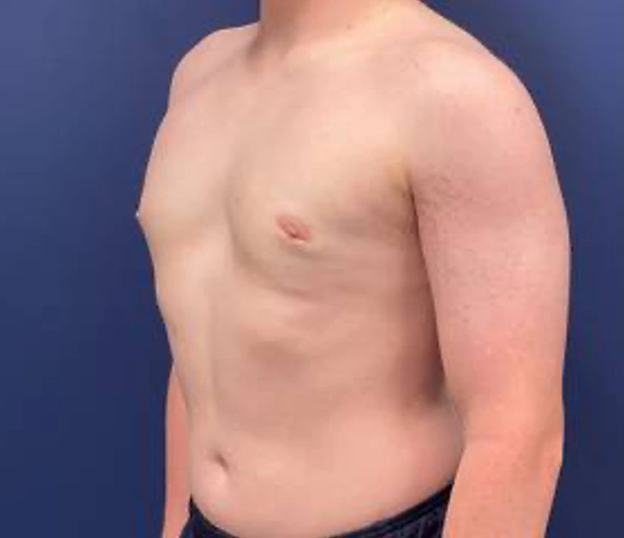 Gynecomastia-Case--214 | After Gynecomastia / Male Breast Reduction 3