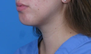 Case--293 | After Submental Liposuction 2