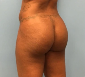 Brazilian-Butt-Lift-Case--271 | After Brazilian Butt Lift 1