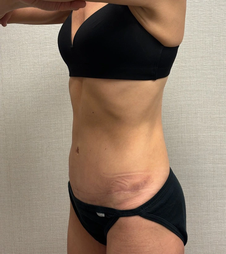 Revision-Tummy-Tuck-Case--23643 | After Tummy Tuck 2