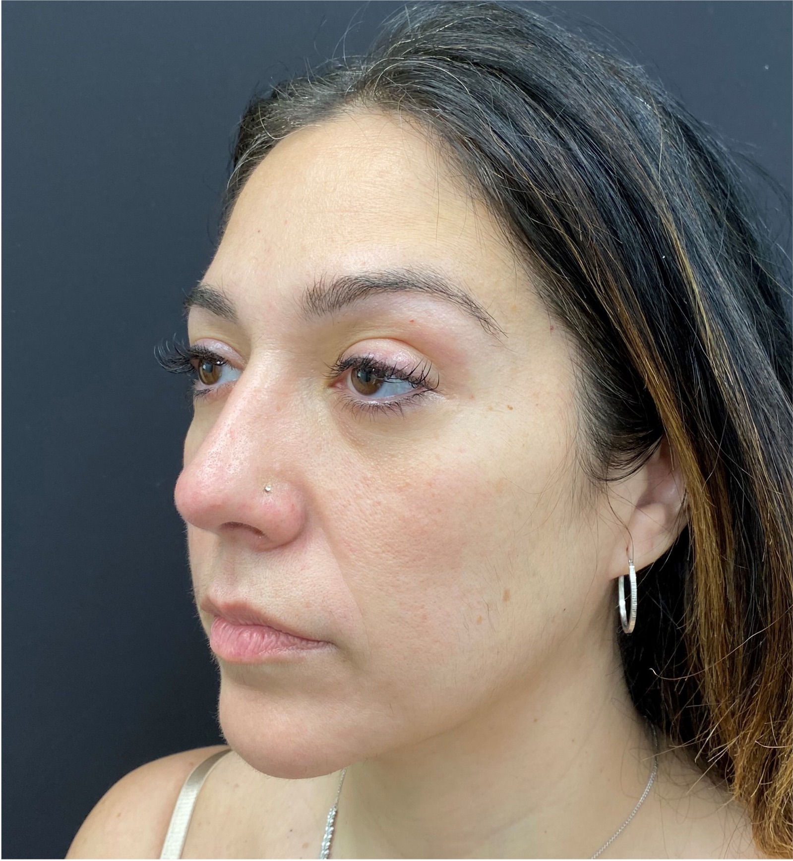 Rhinoplasty-Case--377 | After Rhinoplasty 1