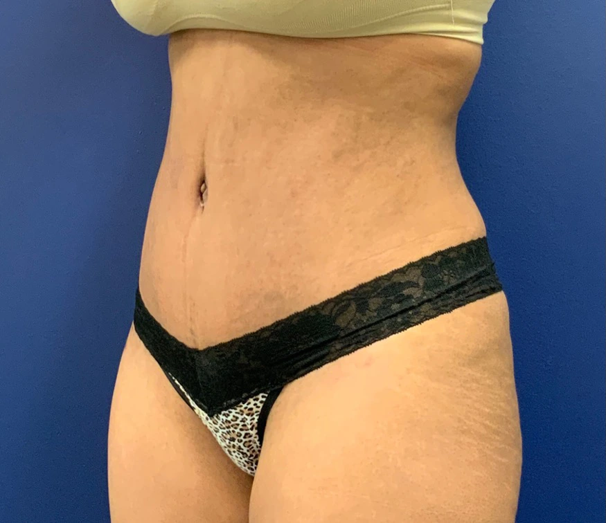 Lipoabdominoplasty-Case--21755 | After Tummy Tuck 2