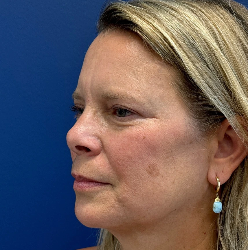 Blepharoplasty-Case--13622 | After Eyelid Surgery 3