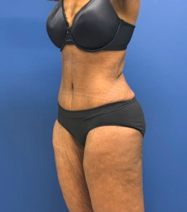 Tummy-Tuck-Case--28714 | After Tummy Tuck 2