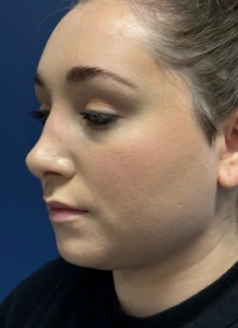 Submental-Liposuction-Case--29107 | After Submental Liposuction 1