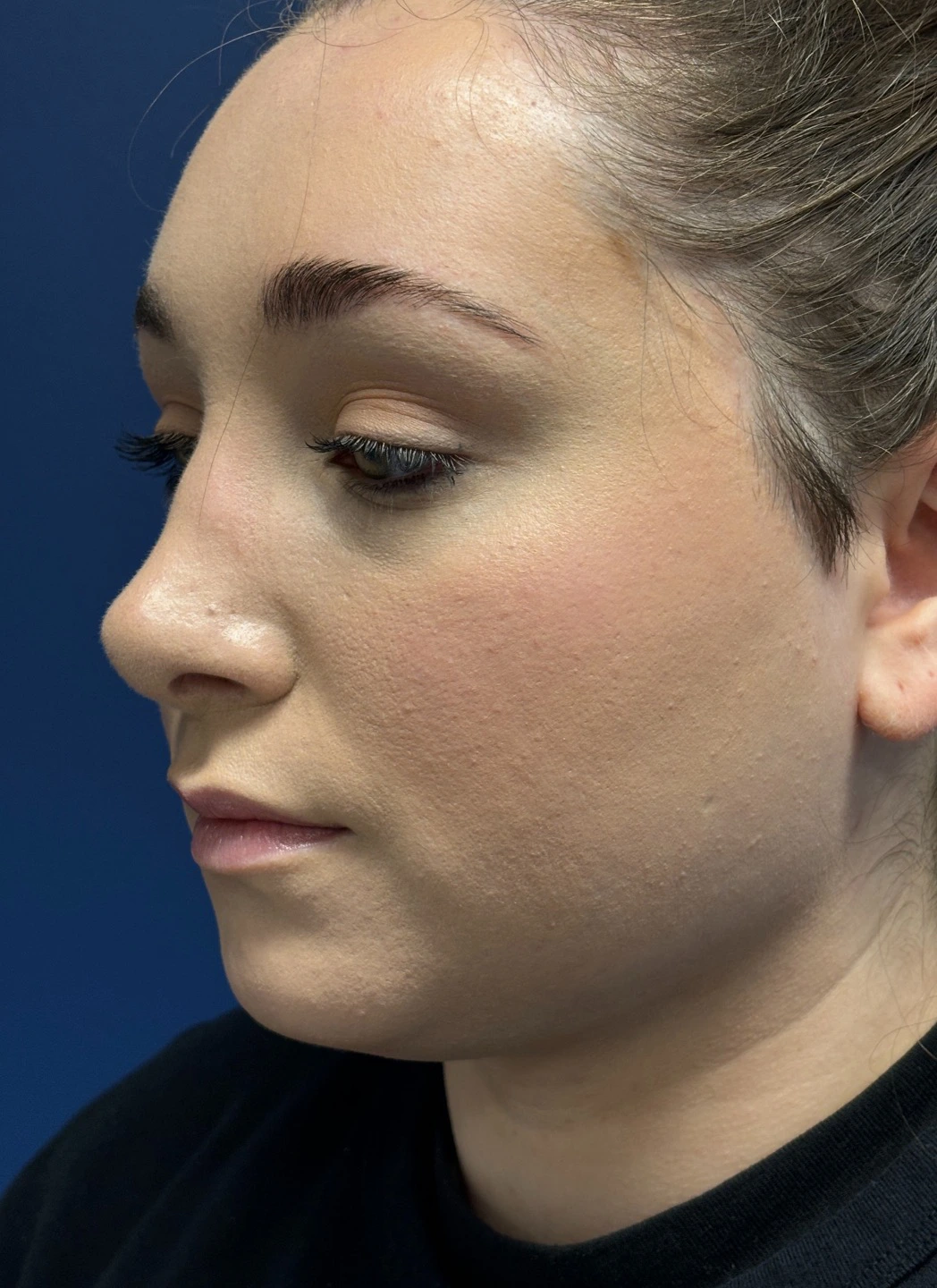 Submental-Liposuction-Case--29107 | After Submental Liposuction 1