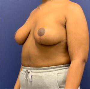 Breast-Reduction-Case--27281 | After Breast Reduction 2