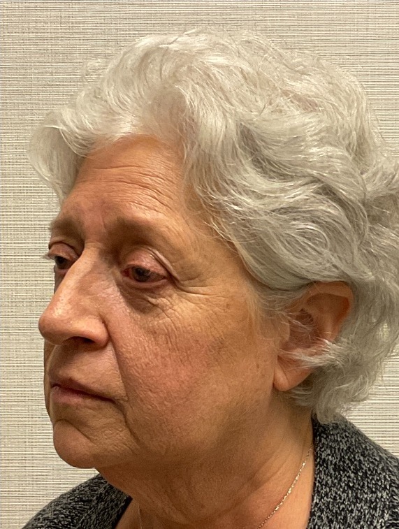 Rhinoplasty-Case--25467 | After Rhinoplasty 3