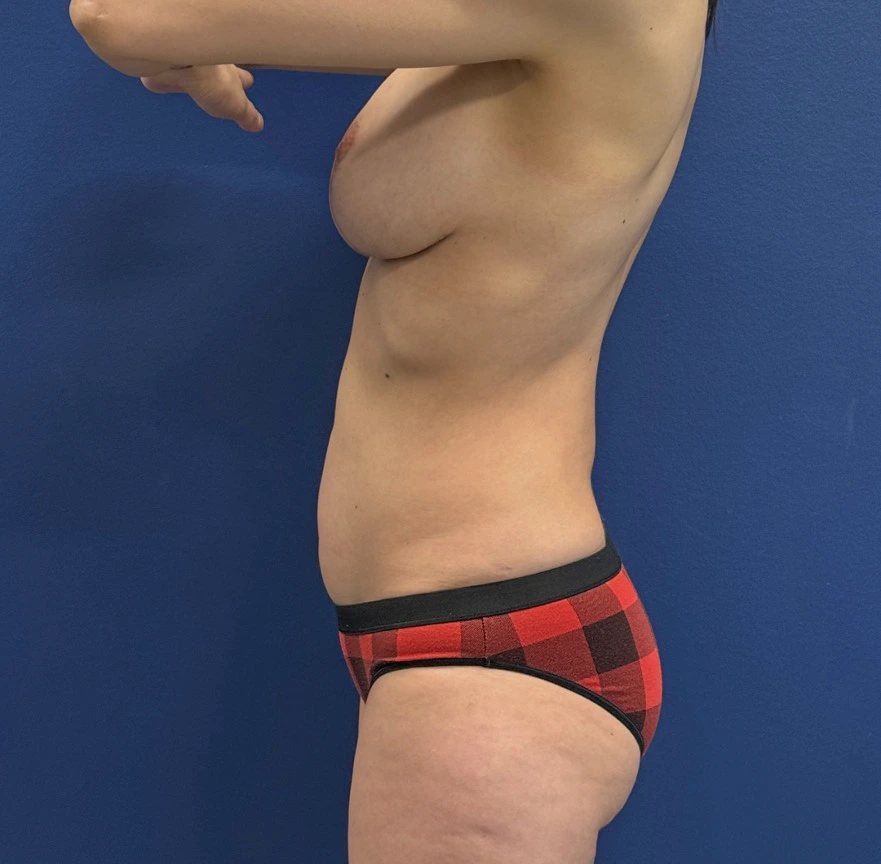 Breast-Augmentation-Lift-Case--28152 | After Breast Augmentation With Lift 3