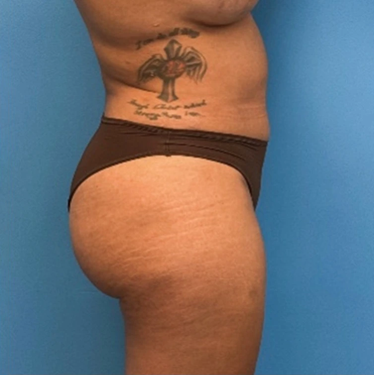 Case--25704 | After Liposuction 3