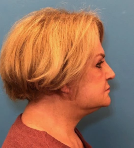 Facelift-Case--14460 | After Dr. Samir Rao 2