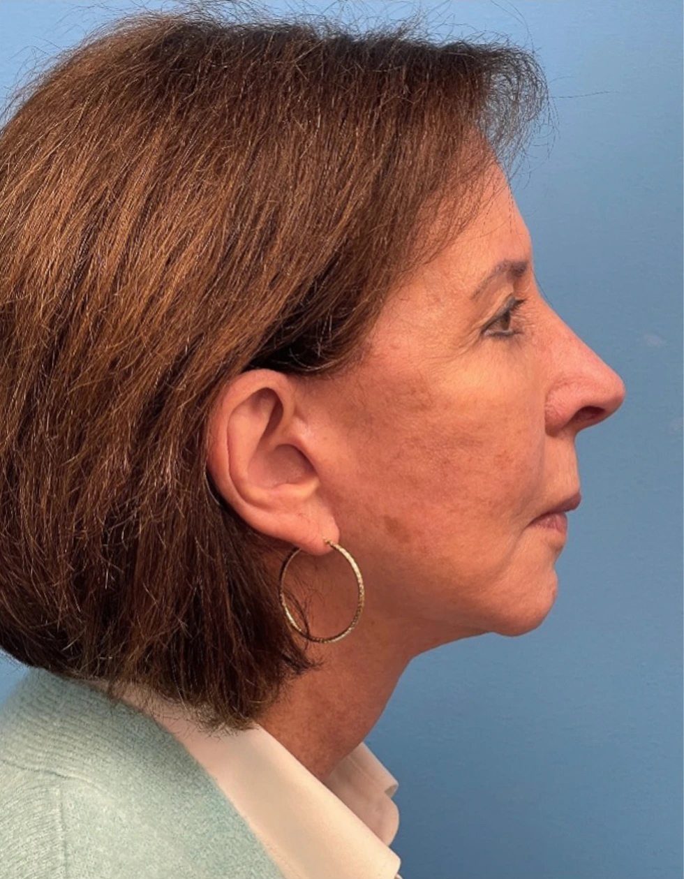 Facelift-Case--25941 | After Facelift 3