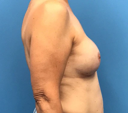 Case--133 | After Breast Reconstruction 3