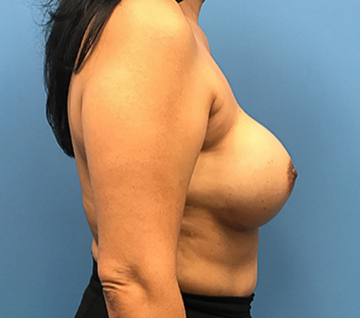 Case--134 | After Breast Reconstruction 3