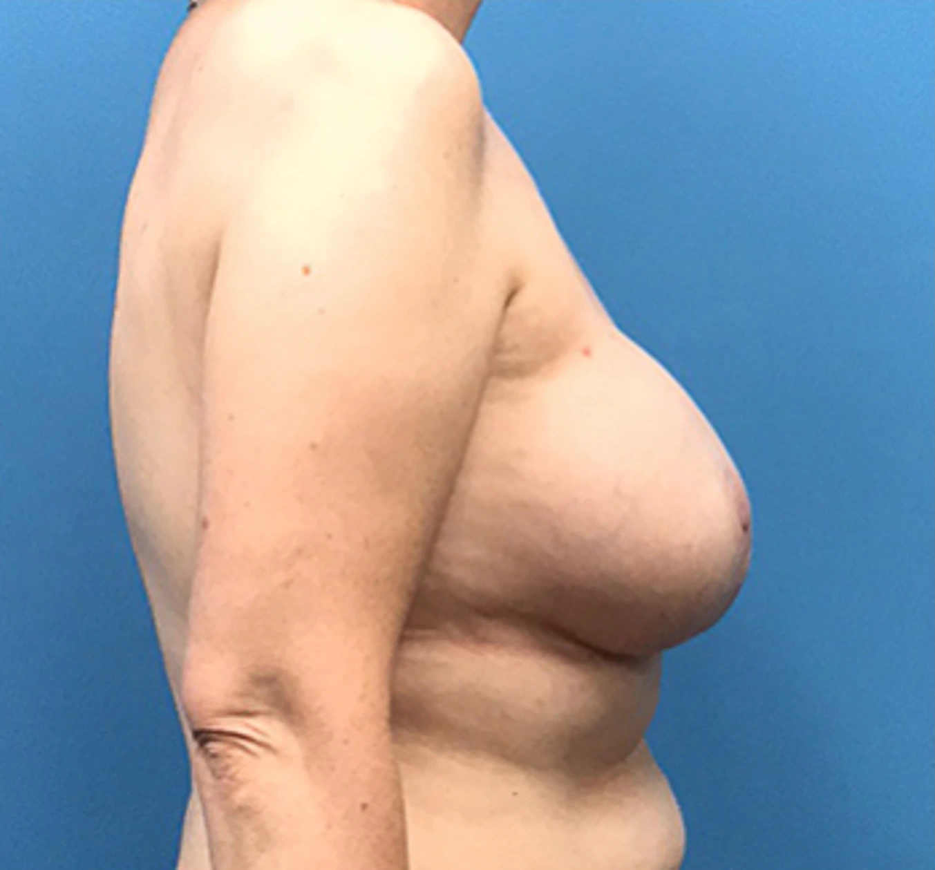 Case--135 | After Breast Reconstruction 3