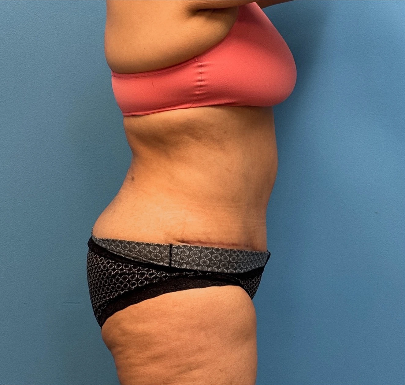 Lipoabdominoplasty-Case--27602 | After Liposuction 3