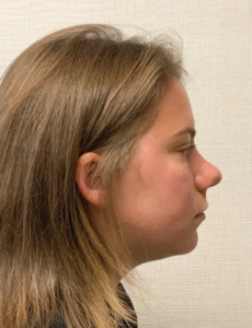 Rhinoplasty-Septoplasty-Case--23611 | After Rhinoplasty 2