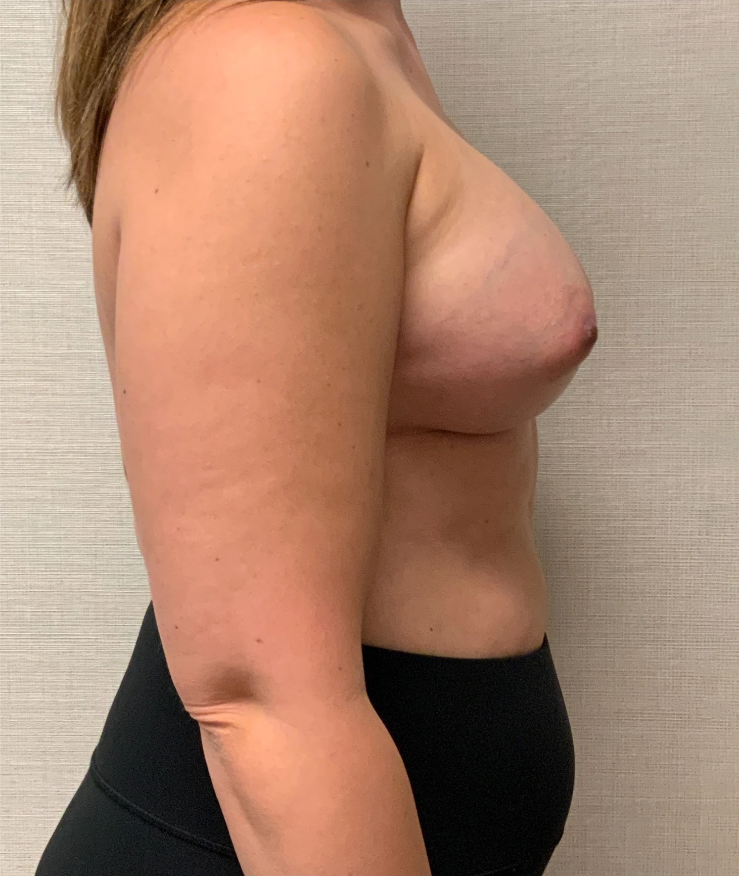 After Breast Augmentation (Right)