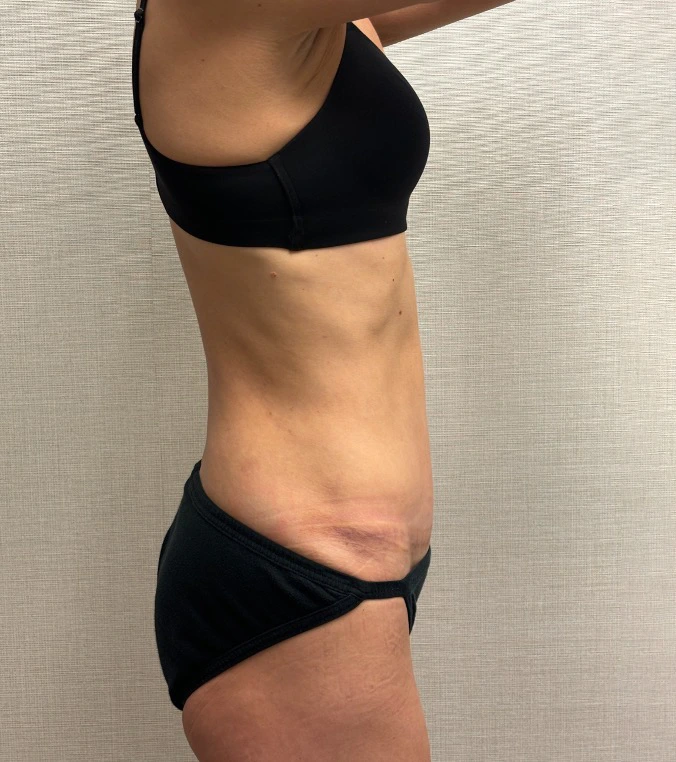 Revision-Tummy-Tuck-Case--23643 | After Tummy Tuck 5