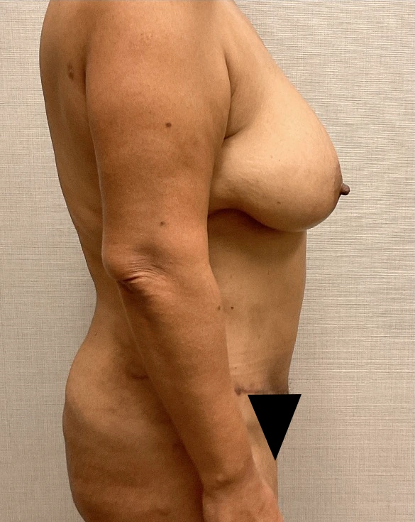 Liposuction-Abdominoplasty-Case--25576 | After Liposuction 3