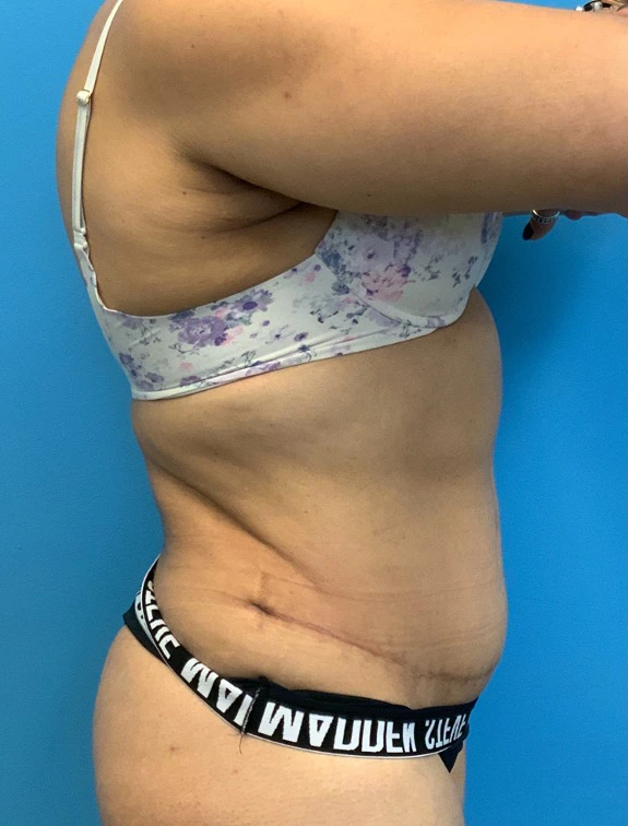 Tummy-Tuck-Case--25988 | After Tummy Tuck 5