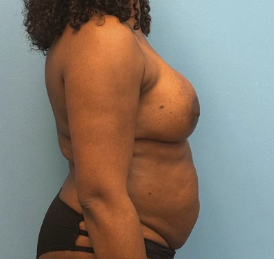 Breast-Reconstruction-Case--23930 | After Breast Reconstruction 3