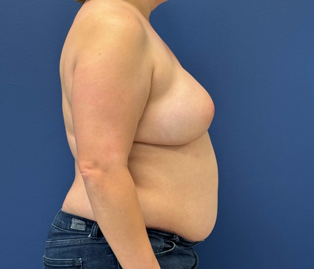 DIEP-Flap-Case--28021 | After DIEP Flap 3