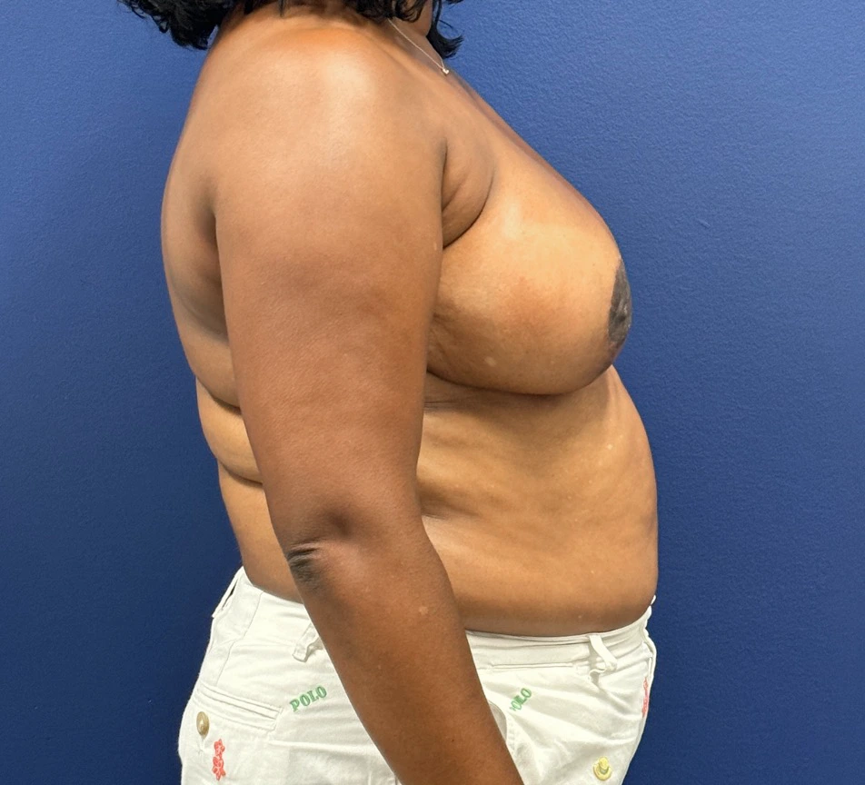 Breast-Reduction-Case--28242 | After Breast Reduction 3