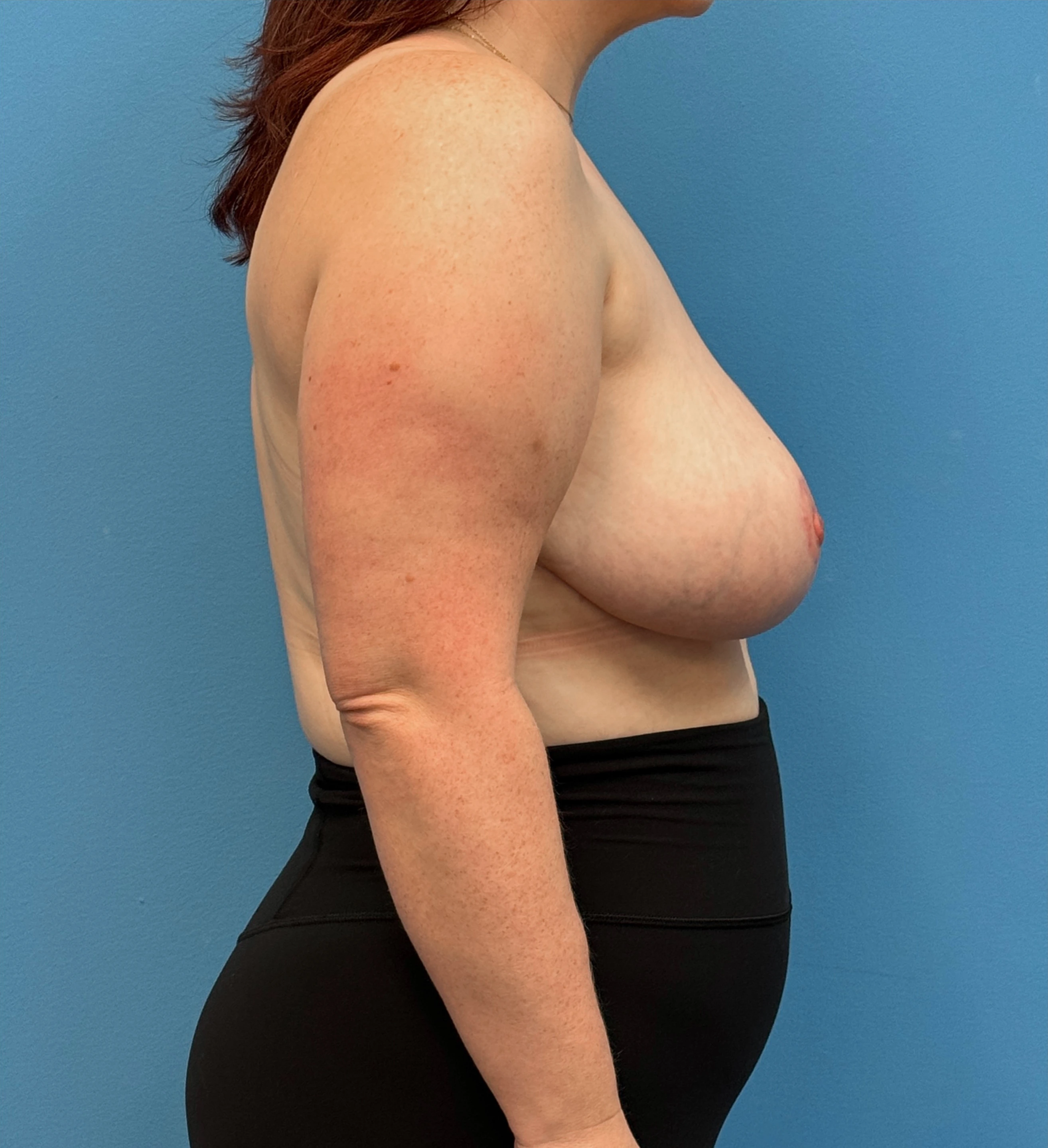 Breast-Reduction-Case--28338 | After Breast Reduction 3