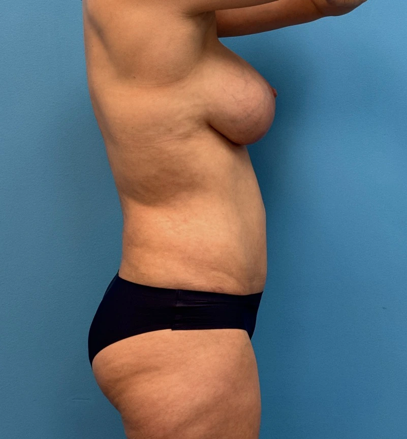 Breast-Augmentation-Tummy-Tuck-Case--28080 | After Body Lift 3