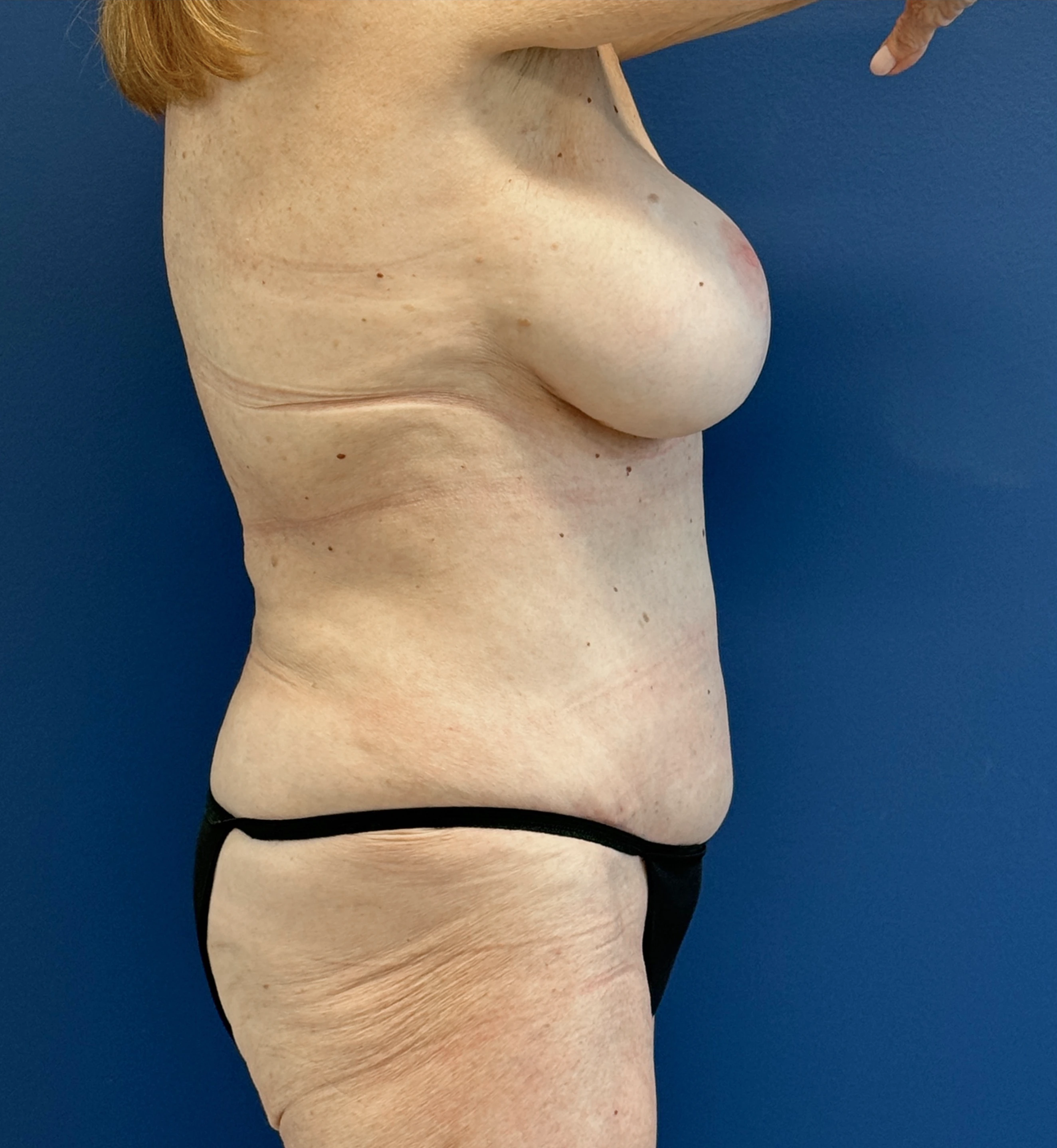 Lipoabdominoplasty-Case--27935 | After Liposuction 5