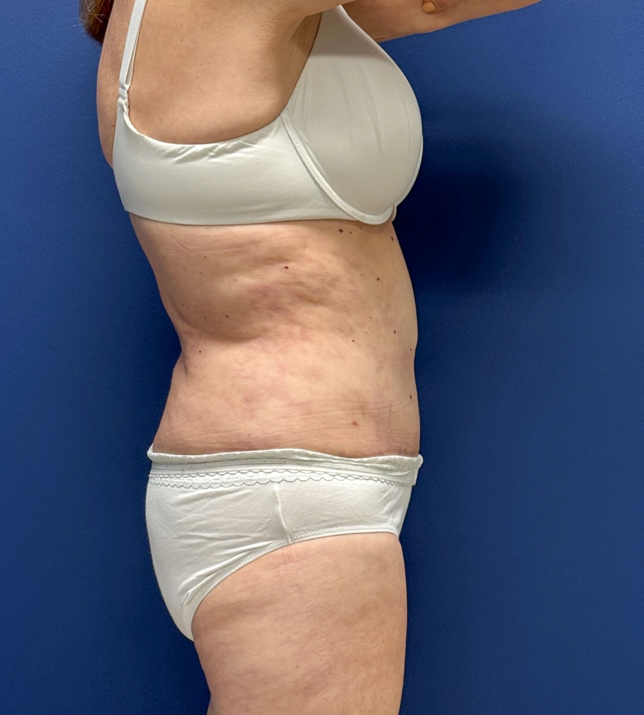 Abdominoplasty-Case--23690 | After Liposuction 4