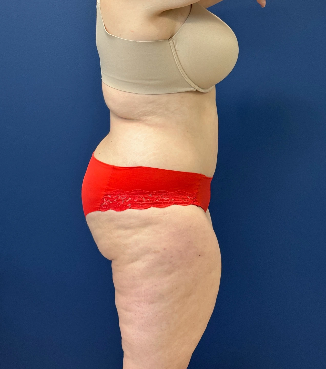 Tummy-Tuck-Case--28426 | After Tummy Tuck 3